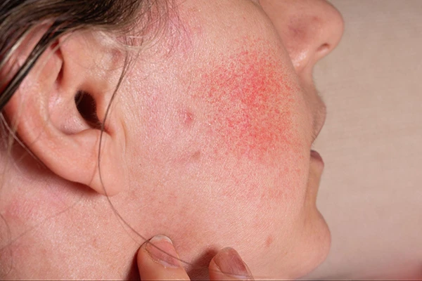 A person with rashes and bumps on skin