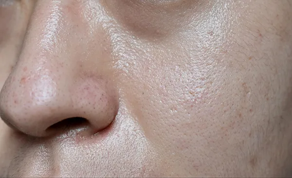 Enlarged pores and excess sebum on the face