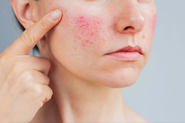 Redness and dryness around the cheek area with enlarged pores around the nose