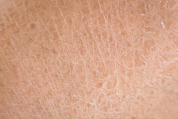 Scaly texture on dry skin